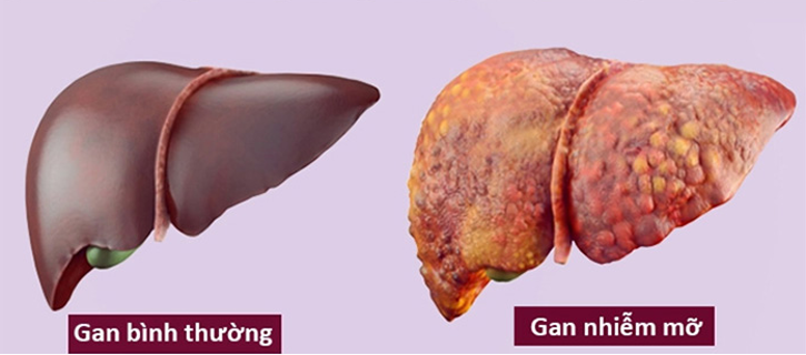 Bốn cách được quảng cáo giúp giải độc gan nhưng có thể làm hại bạn